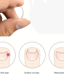 Ayak Tırnak Batmasını Önleyen Metal Aparat – Sağlıklı ve Konforlu Çözüm